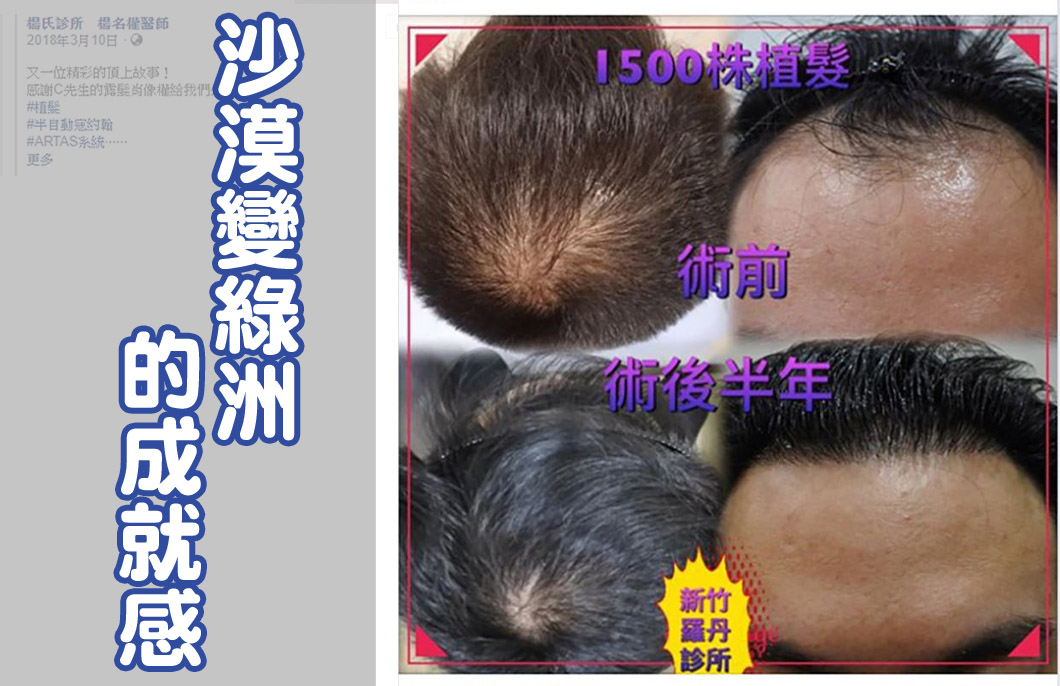 【植髮】楊名權醫師：沙漠變綠洲的成就感